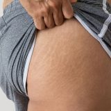 6 dicas de como acabar com as estrias